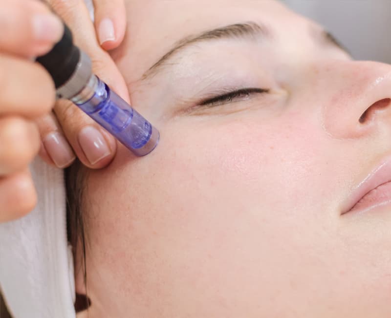 Dermapen Skinderma Coruña